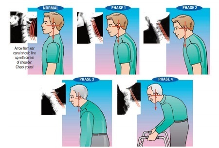 neck posture problems phases