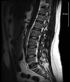 lower back disc bulge image
