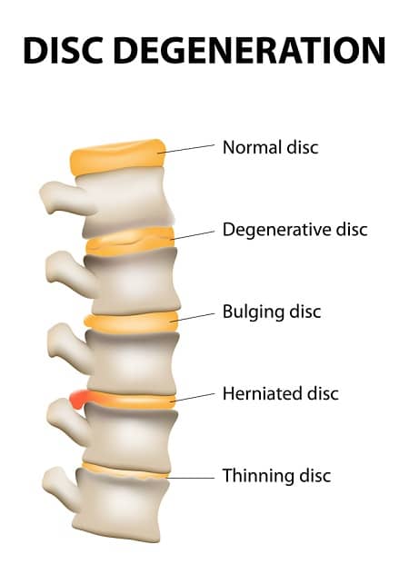 lumbar disc degneration