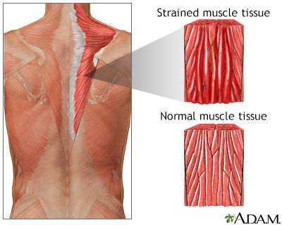 how does a pulled muscle look like