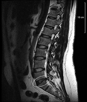 lower back disc bulge